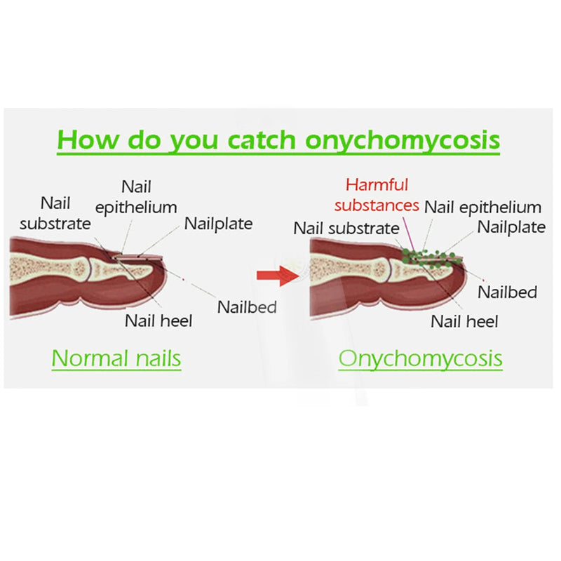 Fungal Nail Treatment